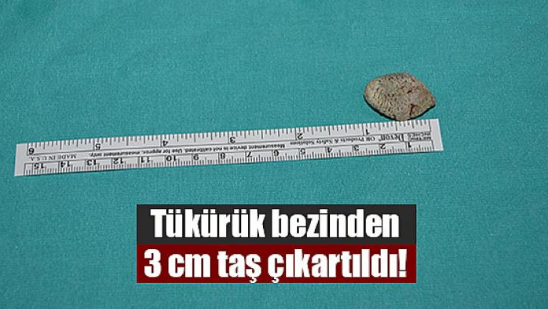 Tükürük bezinden 3 cm taş çıkartıldı!