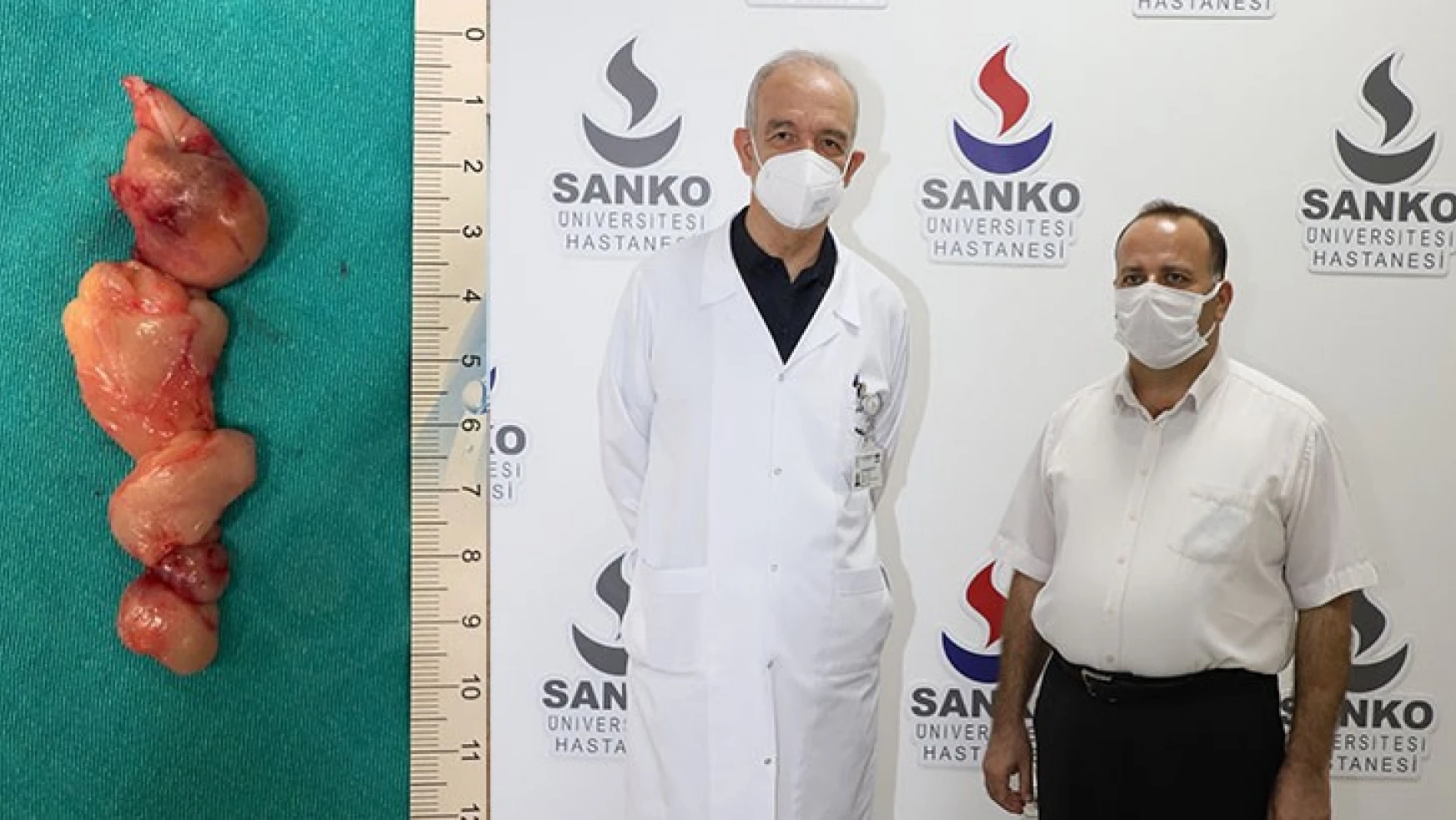 SANKO Üniversitesi Hastanesi'nde başarılı ameliyat
