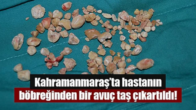 Kahramanmaraş'ta hastanın böbreğinden bir avuç taş çıkartıldı!